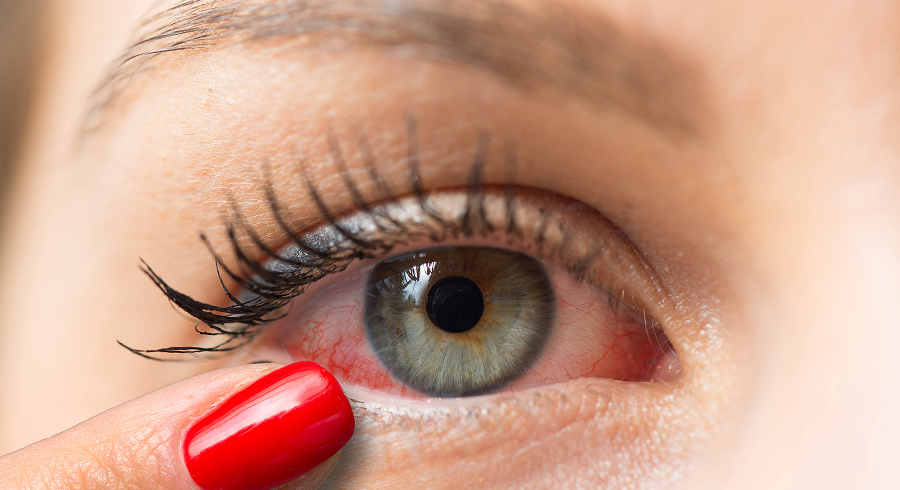 Лечение зуда в глазах