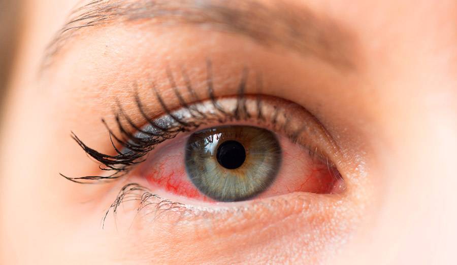 Аллергия или синдром сухого глаза?