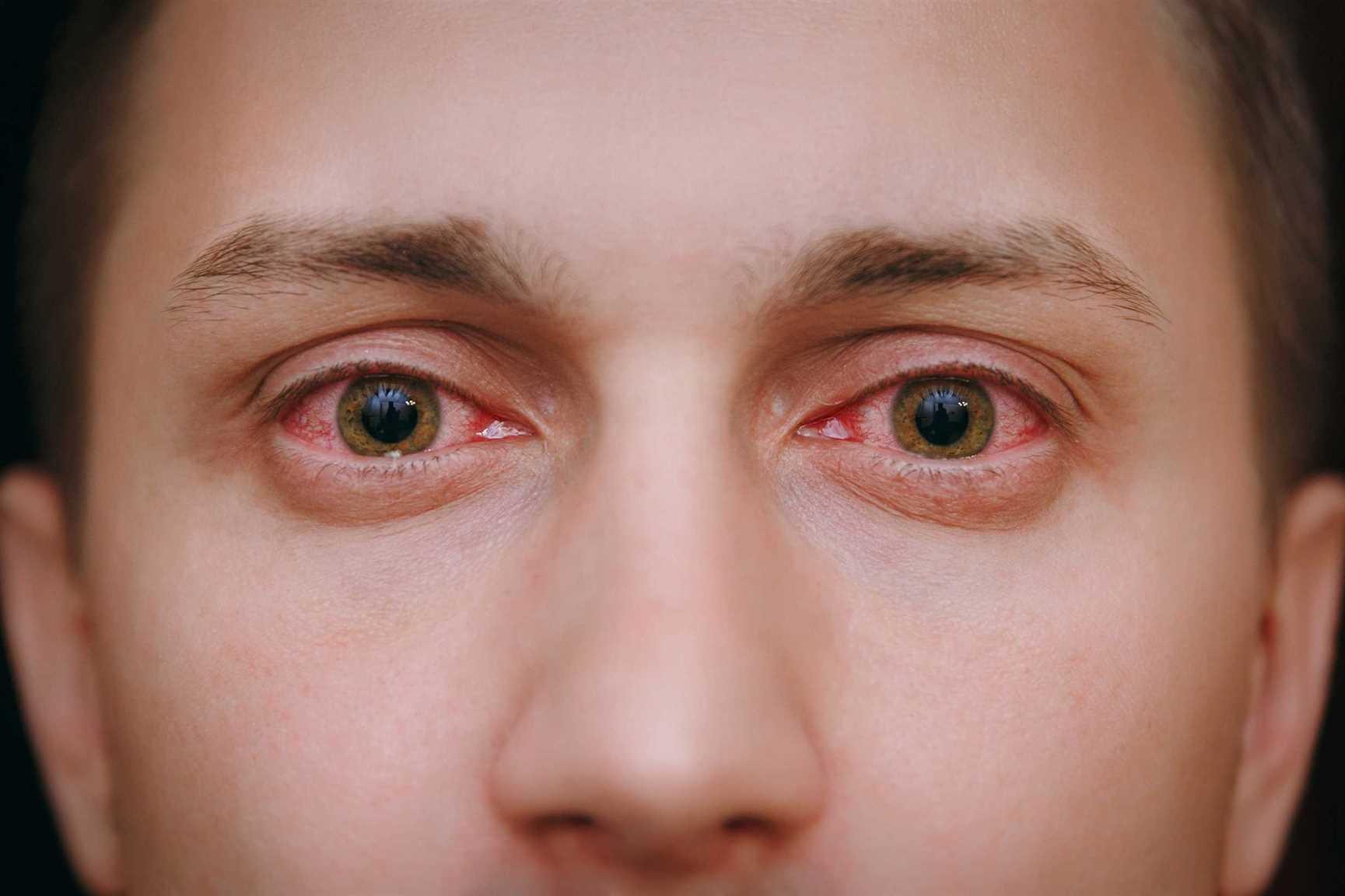 почему после марихуаны краснеют глаза