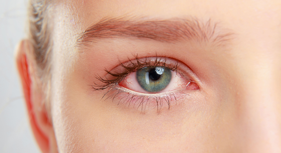 Что закапать в глаза, когда они нестерпимо чешутся?